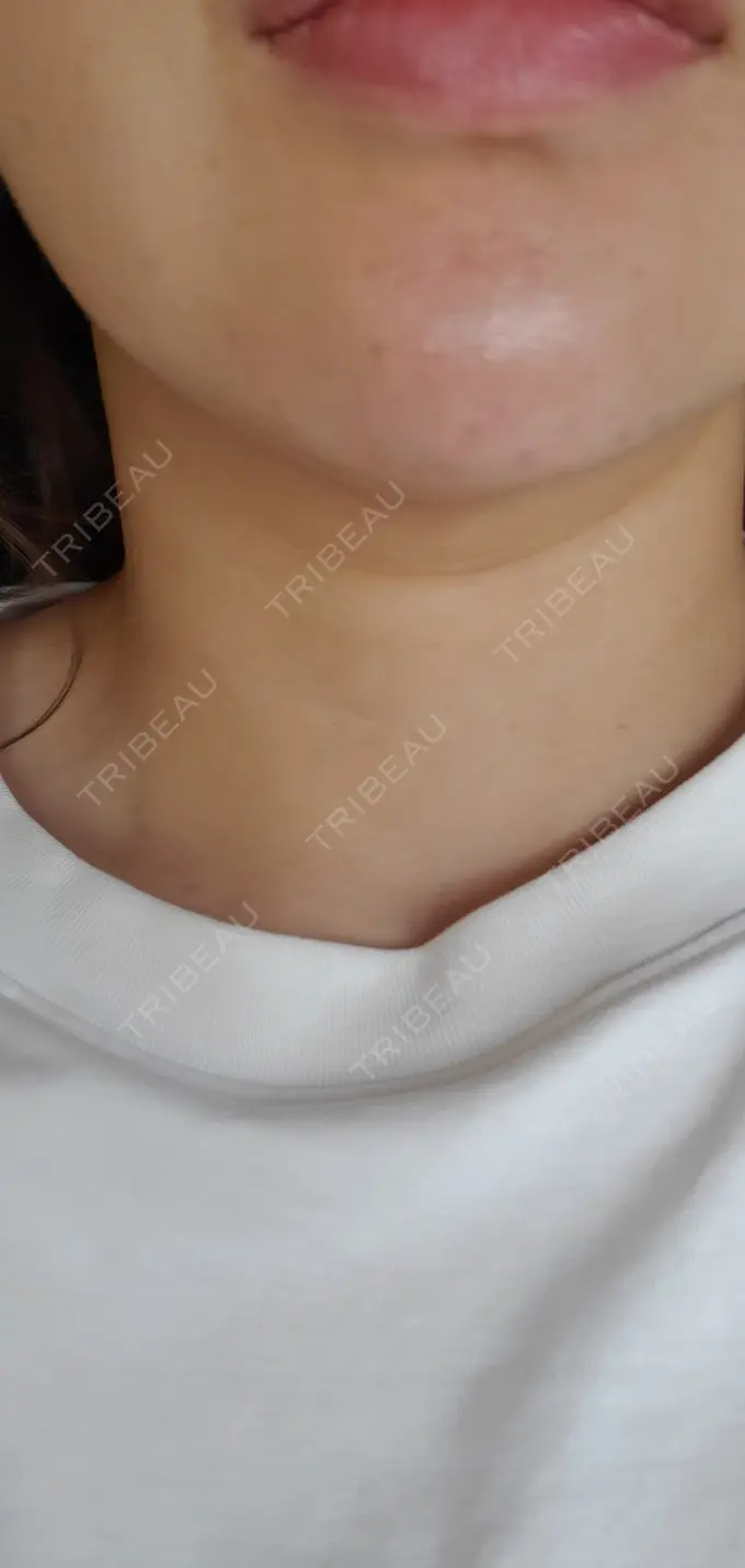 ヒアルロン酸注入（あご） / シワ取りボトックス / ボトックス（額） 湘南美容クリニック 浜松院 DAY 1 メイン用