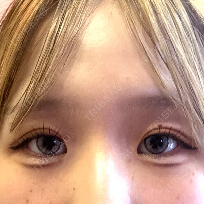 二重埋没 / ヒアルロン酸注入（涙袋） 湘南美容クリニック 宇都宮院 DAY 3 メイン用