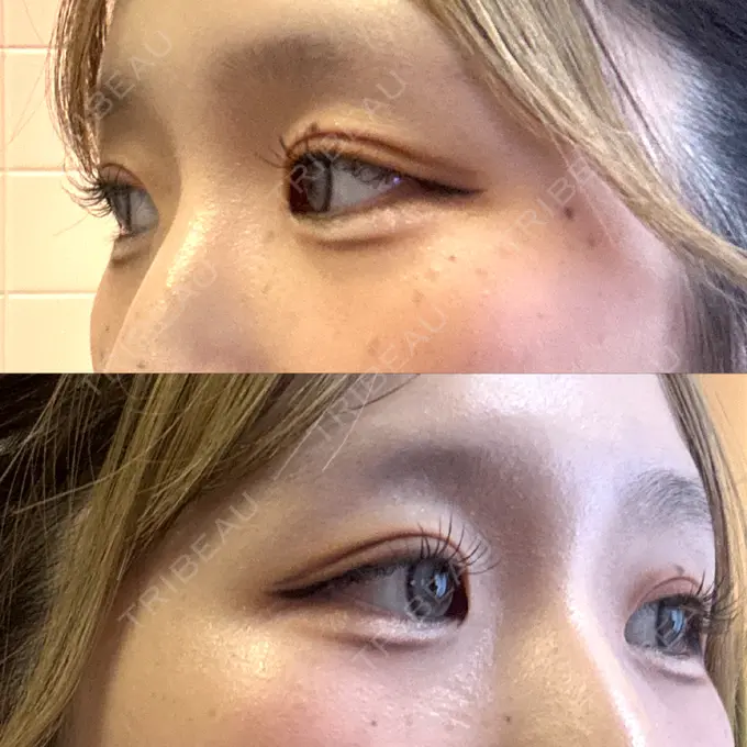 二重埋没 / ヒアルロン酸注入（涙袋） 湘南美容クリニック 宇都宮院 DAY 3 メイン用