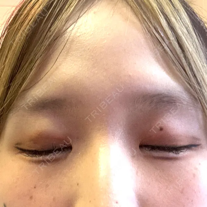 二重埋没 / ヒアルロン酸注入（涙袋） 湘南美容クリニック 宇都宮院 DAY 3 メイン用