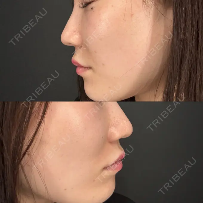 鼻翼基部形成（貴族手術） eクリニック 大阪梅田 西日本統括院 AFTER メイン用