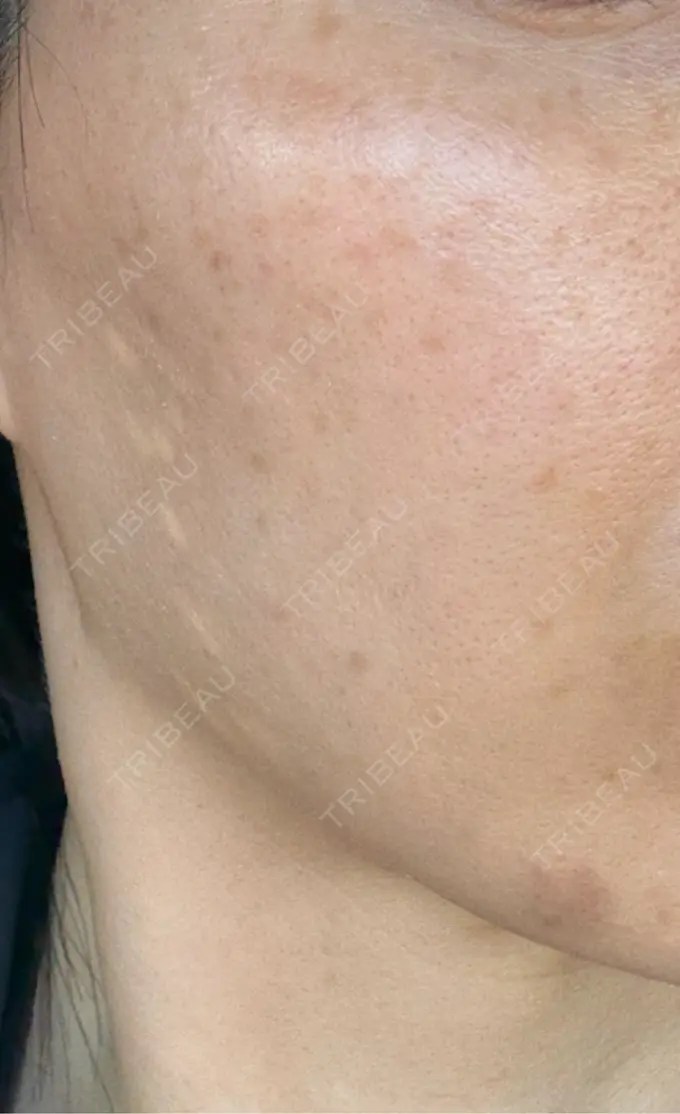 イオン導入 / ピーリング（ハリ・ツヤ） / ルメッカ ルラ美容クリニック 名古屋栄院 / ルラスキンクリニック 名古屋栄院 AFTER メイン用