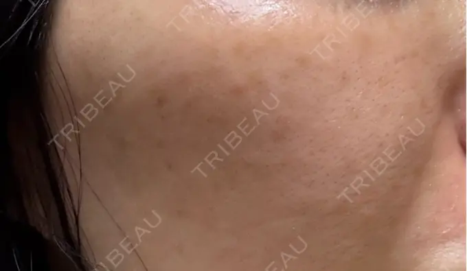 イオン導入 / ピーリング（ハリ・ツヤ） / ルメッカ ルラ美容クリニック 名古屋栄院 / ルラスキンクリニック 名古屋栄院 DAY 11 メイン用