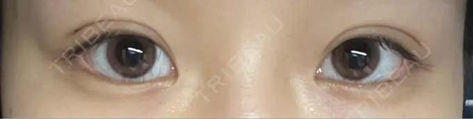 二重埋没 恵聖会クリニック 京橋院 DAY 15 メイン用