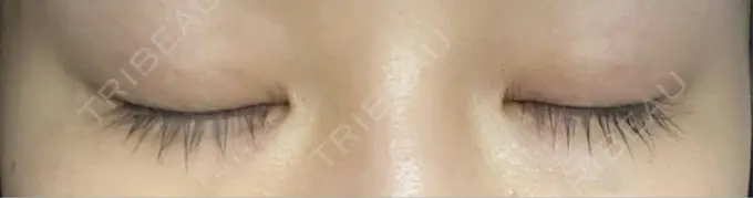 二重埋没 恵聖会クリニック 京橋院 DAY 15 メイン用