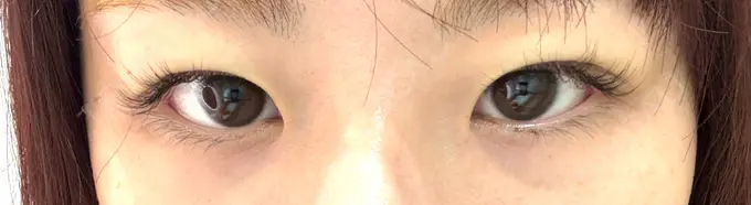 二重埋没 水の森美容クリニック 東京渋谷院 DAY 1 メイン用