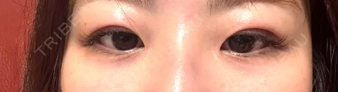 二重埋没 水の森美容クリニック 東京渋谷院 DAY 1 メイン用