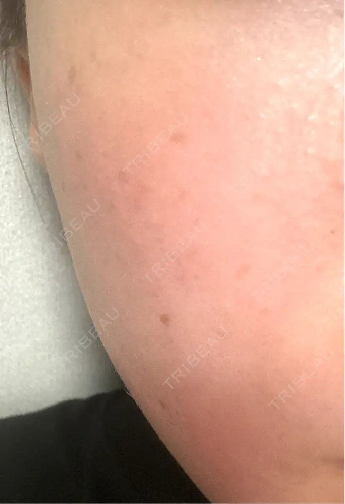 ピーリング（ニキビ・毛穴） ルラ美容クリニック 横浜院 AFTER メイン用