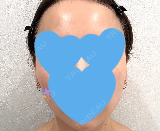 糸リフト / シワ取りボトックス / ボトックス（眉間） アリエル美容クリニック 横浜院 DAY 25 メイン用