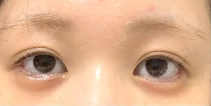 目尻切開 / タレ目形成・グラマラスライン（埋没） LOUIS CLINIC 二子玉川院【ルイクリニック】 AFTER メイン用