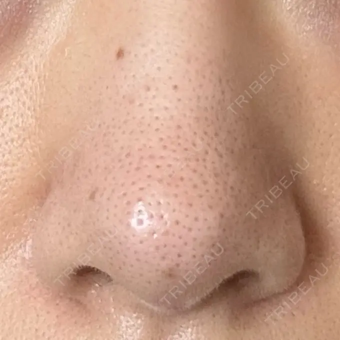 アグネス 日本美容・医療クリニック 六本木院 AFTER メイン用