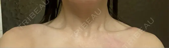 ボトックス（肩） APスキンクリニック銀座 DAY 2 メイン用