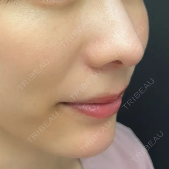 鼻尖形成（切開） eクリニック 富山駅前院 AFTER メイン用
