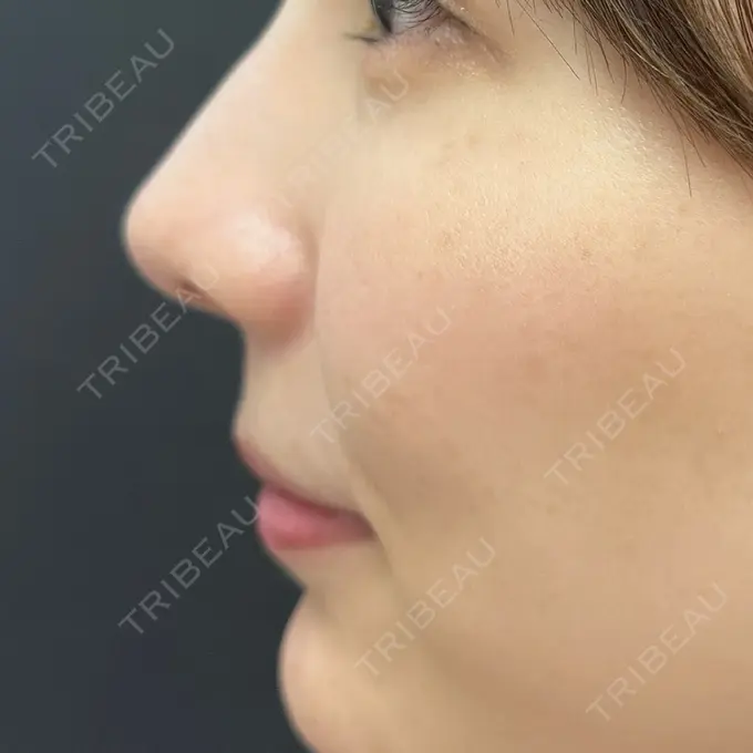 鼻尖形成（切開） eクリニック 富山駅前院 DAY 46 メイン用