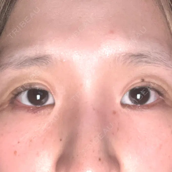 二重埋没 / ヒアルロン酸注入（涙袋） 湘南美容クリニック 宇都宮院 DAY 4 メイン用