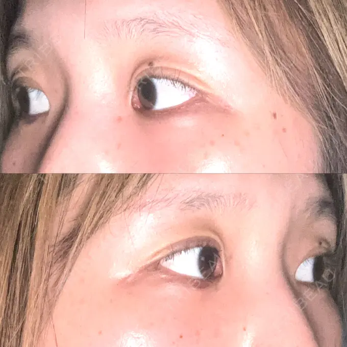 二重埋没 / ヒアルロン酸注入（涙袋） 湘南美容クリニック 宇都宮院 DAY 4 メイン用