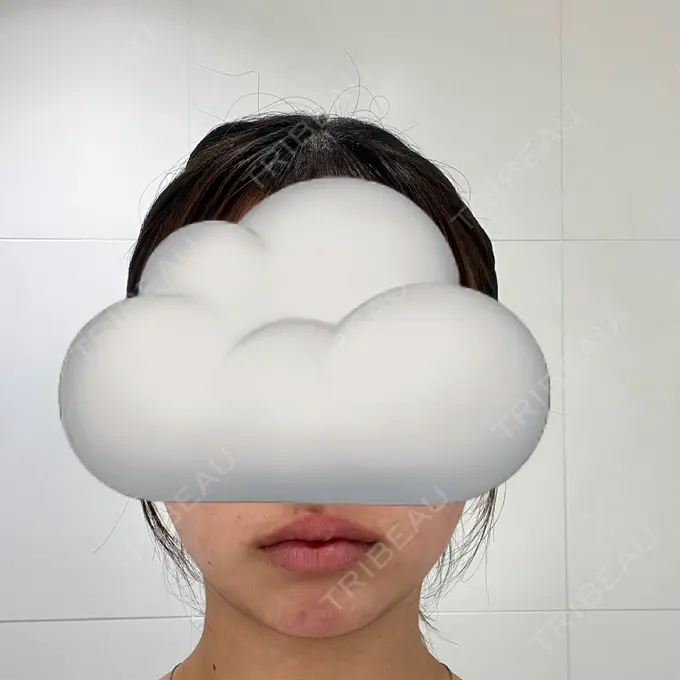 ボトックス（あご） / ヒアルロン酸注入（あご） / ヒアルロン酸注入（唇） BELINDA CLINIC（ベリンダクリニック）岡山院 DAY 0 メイン用