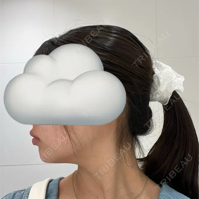 ボトックス（あご） / ヒアルロン酸注入（あご） / ヒアルロン酸注入（唇） BELINDA CLINIC（ベリンダクリニック）岡山院 DAY 0 メイン用