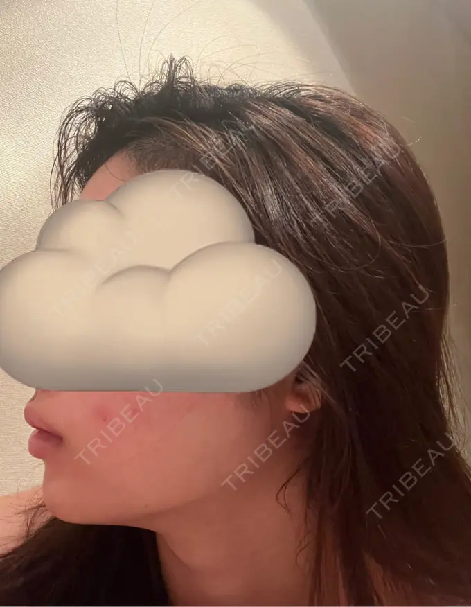 ボトックス（あご） / ヒアルロン酸注入（あご） / ヒアルロン酸注入（唇） BELINDA CLINIC（ベリンダクリニック）岡山院 DAY 4 メイン用