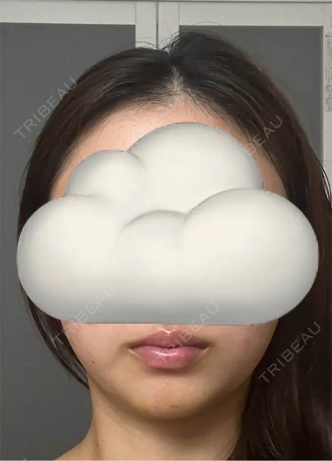 ボトックス（あご） / ヒアルロン酸注入（あご） / ヒアルロン酸注入（唇） BELINDA CLINIC（ベリンダクリニック）岡山院 AFTER メイン用