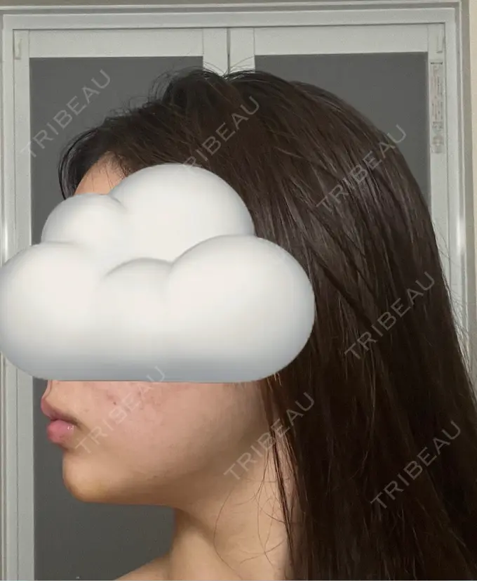 ボトックス（あご） / ヒアルロン酸注入（あご） / ヒアルロン酸注入（唇） BELINDA CLINIC（ベリンダクリニック）岡山院 DAY 5 メイン用