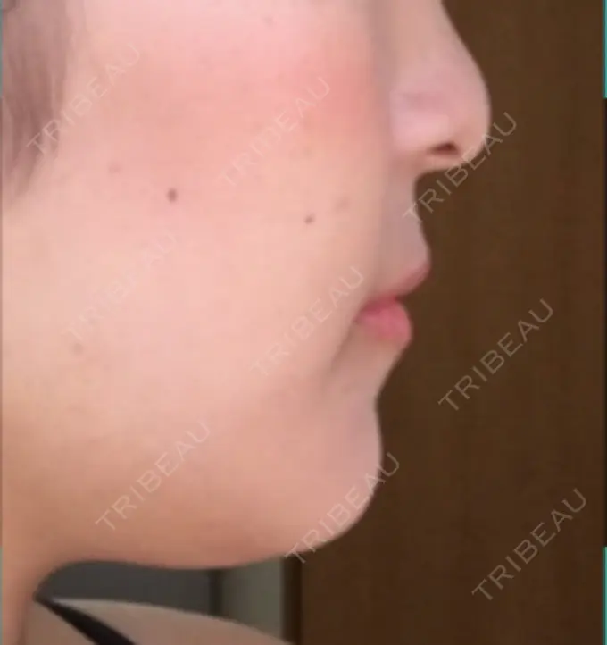 バッカルファット除去 / 脂肪吸引（顔） / セットバック 銀座フェイスクリニック（小顔整形・輪郭整形專門） DAY 100 メイン用