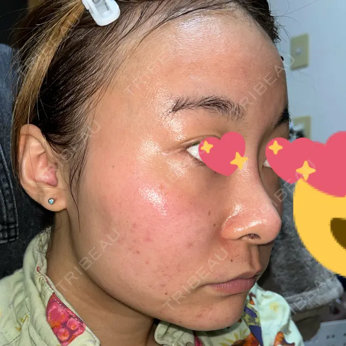 ピコフラクショナルレーザー（毛穴・ニキビ跡） ルラ美容クリニック 大宮院 / ルラスキンクリニック 大宮院 DAY 70 メイン用