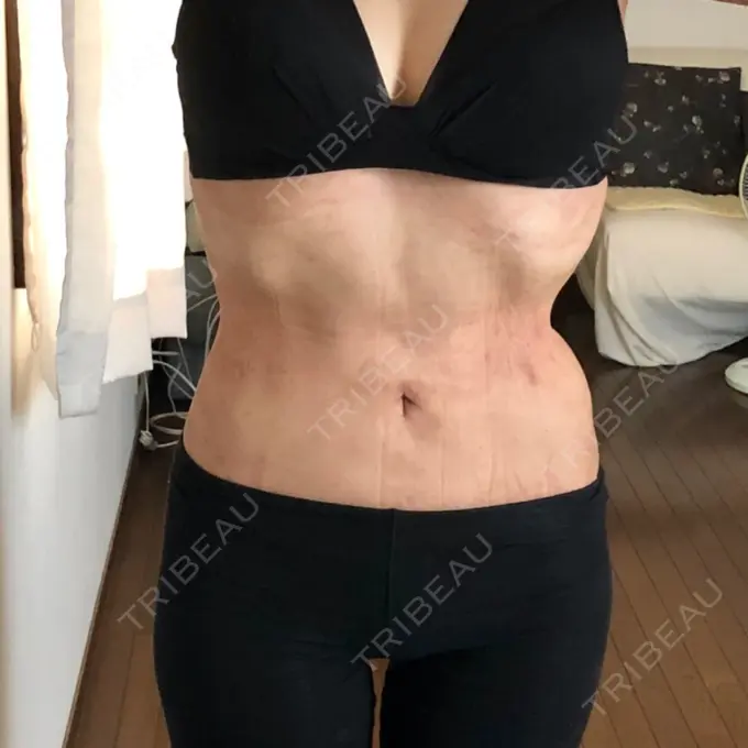 脂肪吸引（お腹） 城本クリニック 富山院 DAY 61 メイン用