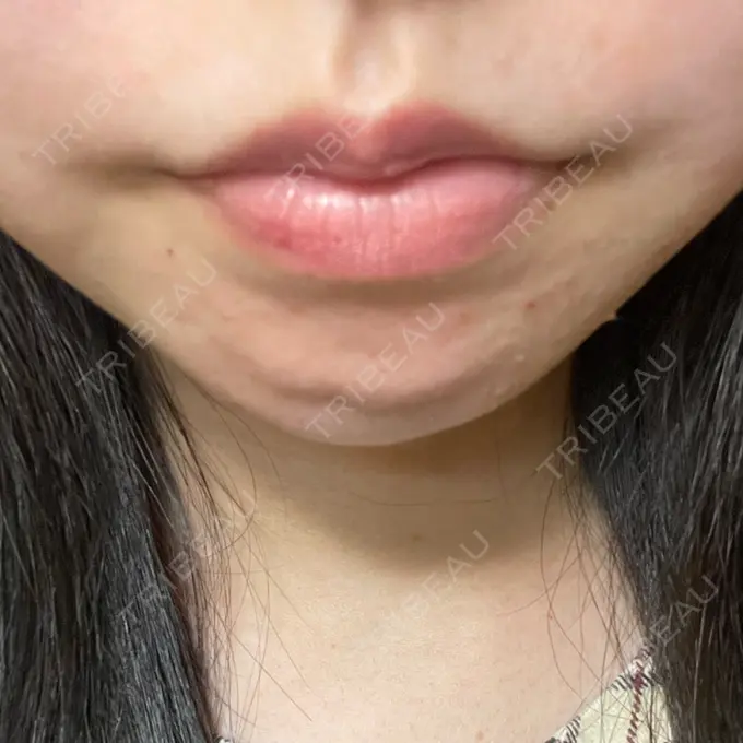 ボトックス（あご） / ボトックス（口角） / シワ取りボトックス LE CLINIC DAY 1 メイン用