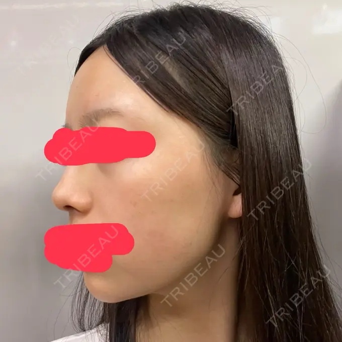 その他（輪郭） ルラ美容クリニック 渋谷本院 AFTER メイン用