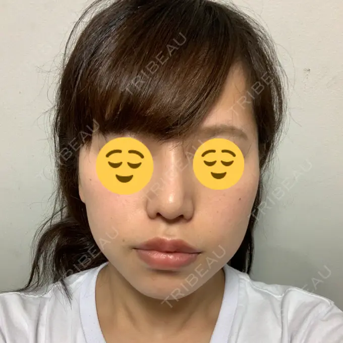 隆鼻術 / 鼻尖形成（切開） / 小鼻縮小（切開） / 軟骨移植 湘南美容クリニック 新橋銀座口院 AFTER メイン用