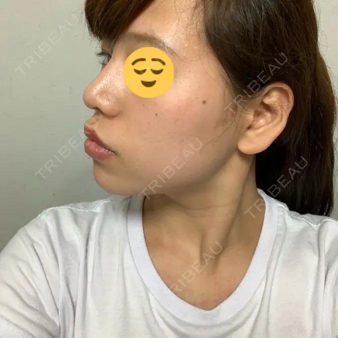 隆鼻術 / 鼻尖形成（切開） / 小鼻縮小（切開） / 軟骨移植 湘南美容クリニック 新橋銀座口院 DAY 61 メイン用