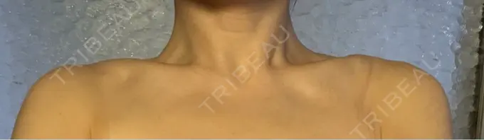 ボトックス（肩） APスキンクリニック銀座 DAY 4 メイン用