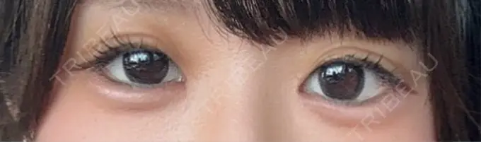 目尻切開 / タレ目形成・グラマラスライン（埋没） LOUIS CLINIC 二子玉川院【ルイクリニック】 DAY 10 メイン用