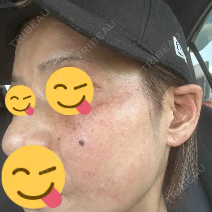 イオン導入 / レーザートーニング（美白・肝斑） 椿クリニック 名古屋院 DAY 14 メイン用