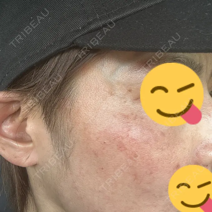 イオン導入 / レーザートーニング（美白・肝斑） 椿クリニック 名古屋院 DAY 14 メイン用