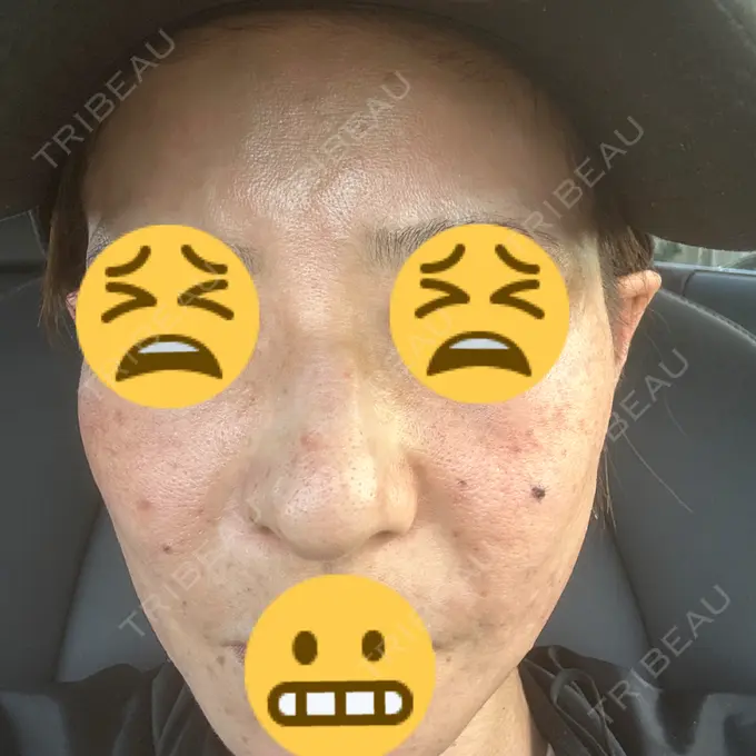 イオン導入 / レーザートーニング（美白・肝斑） 椿クリニック 名古屋院 DAY 14 メイン用