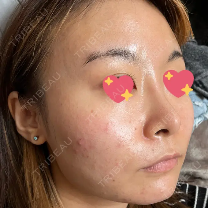 ピコフラクショナルレーザー（毛穴・ニキビ跡） ルラ美容クリニック 大宮院 / ルラスキンクリニック 大宮院 DAY 72 メイン用