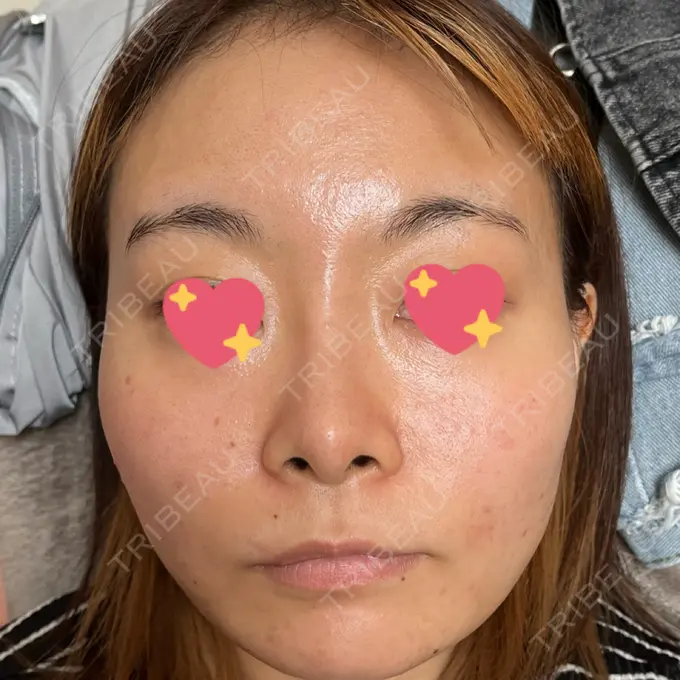 ピコフラクショナルレーザー（毛穴・ニキビ跡） ルラ美容クリニック 大宮院 / ルラスキンクリニック 大宮院 DAY 72 メイン用