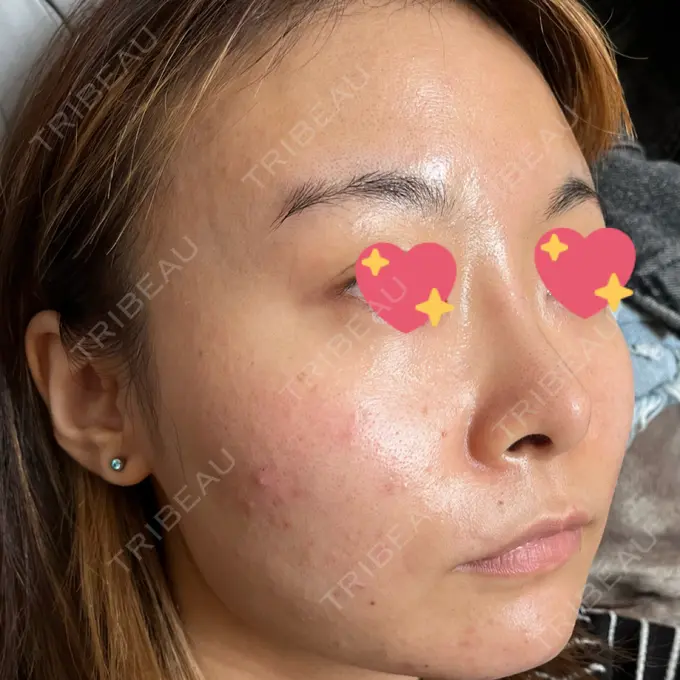 ピコフラクショナルレーザー（毛穴・ニキビ跡） ルラ美容クリニック 大宮院 / ルラスキンクリニック 大宮院 DAY 72 メイン用