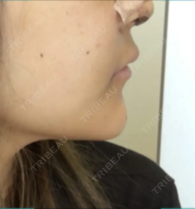 バッカルファット除去 / 脂肪吸引（顔） / セットバック 銀座フェイスクリニック（小顔整形・輪郭整形專門） DAY 168 メイン用