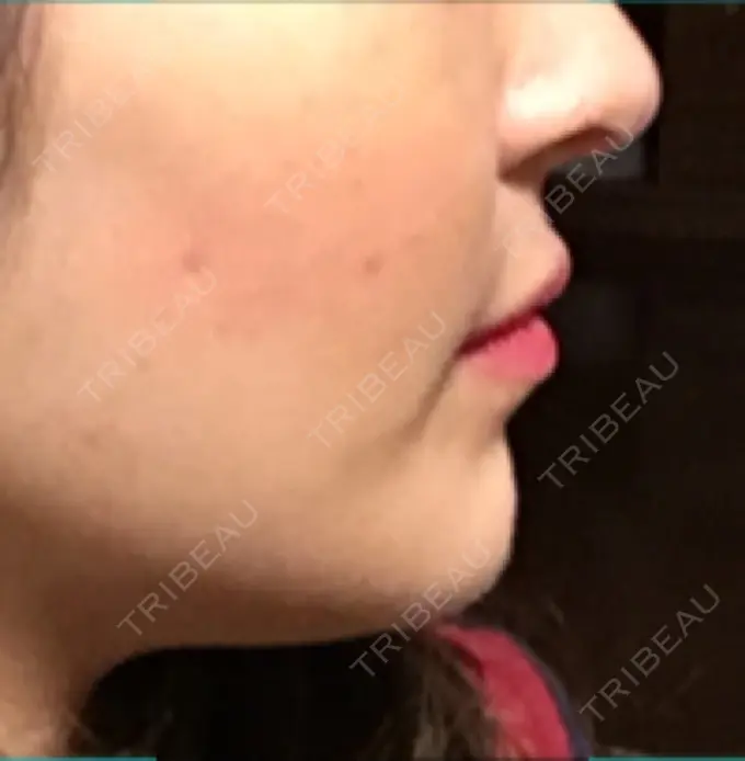 バッカルファット除去 / 脂肪吸引（顔） / セットバック 銀座フェイスクリニック（小顔整形・輪郭整形專門） DAY 207 メイン用