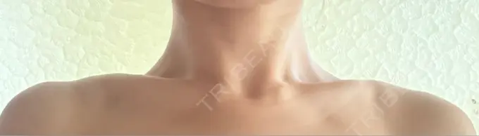 ボトックス（肩） APスキンクリニック銀座 DAY 5 メイン用