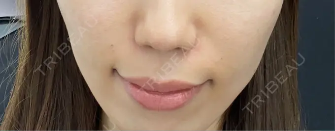 ヒアルロン酸注入（額） / ボトックス（肩） ルラ美容クリニック 大阪本院 AFTER メイン用