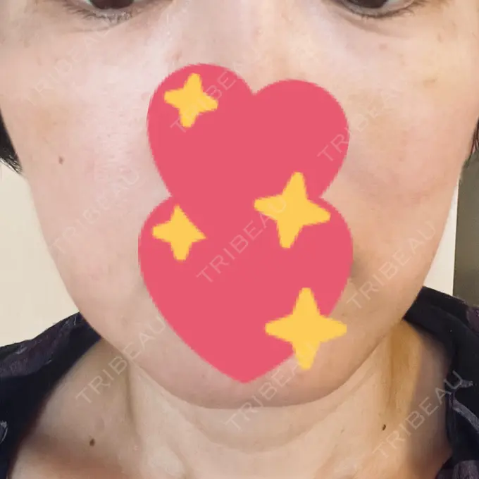 肌育注射（ジュベルックなど） B-LINE CLINIC 大阪院 DAY 7 メイン用