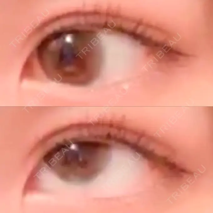 二重切開 よこはまエーブクリニック DAY 31 メイン用