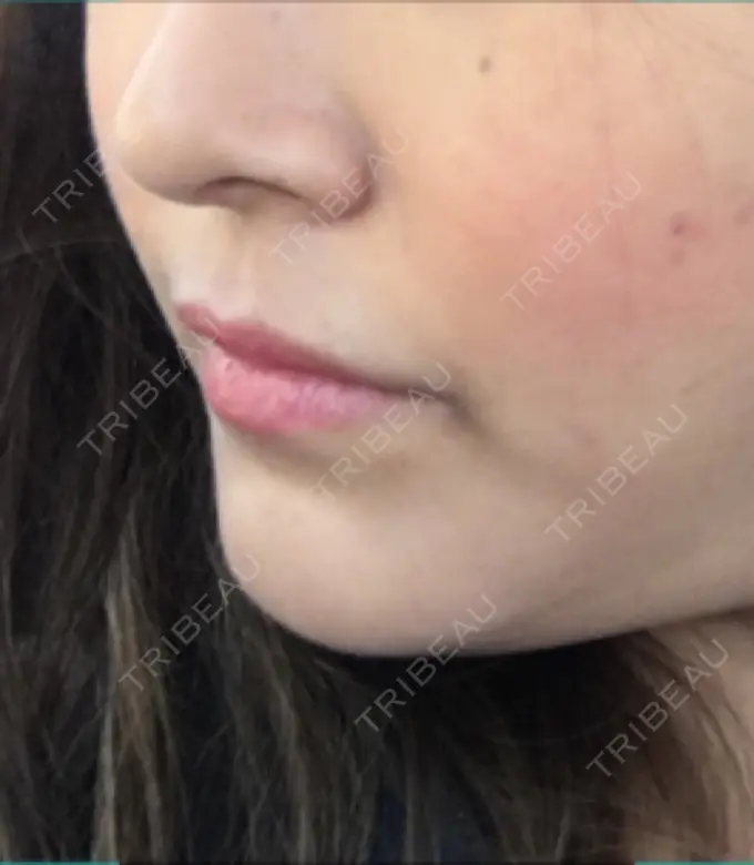 バッカルファット除去 / 脂肪吸引（顔） / セットバック 銀座フェイスクリニック（小顔整形・輪郭整形專門） DAY 225 メイン用