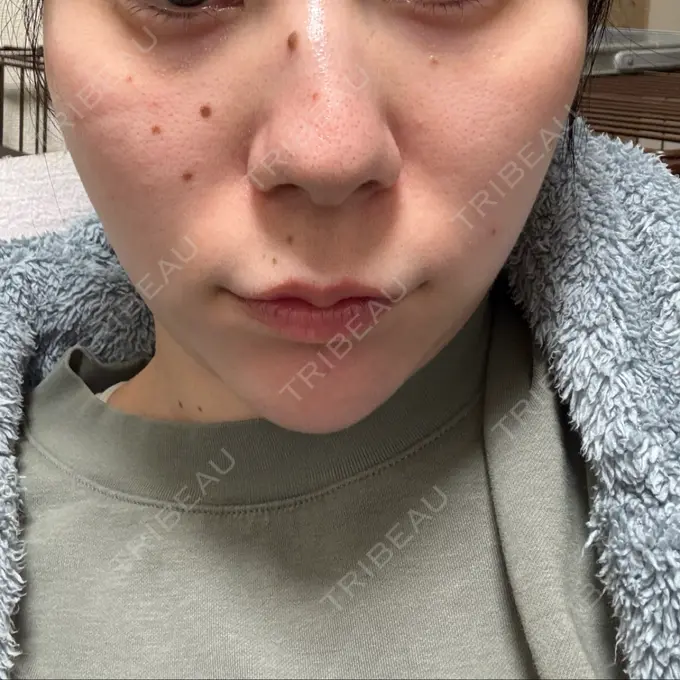 光治療（フォトフェイシャルなど） / RF（高周波）たるみ治療 Wi Clinic（ウィ クリニック） 大宮院 AFTER メイン用