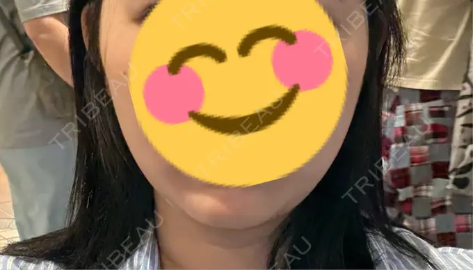 脂肪吸引（顔） / 脂肪吸引注射（顔） ziz CLINIC DAY 1 メイン用