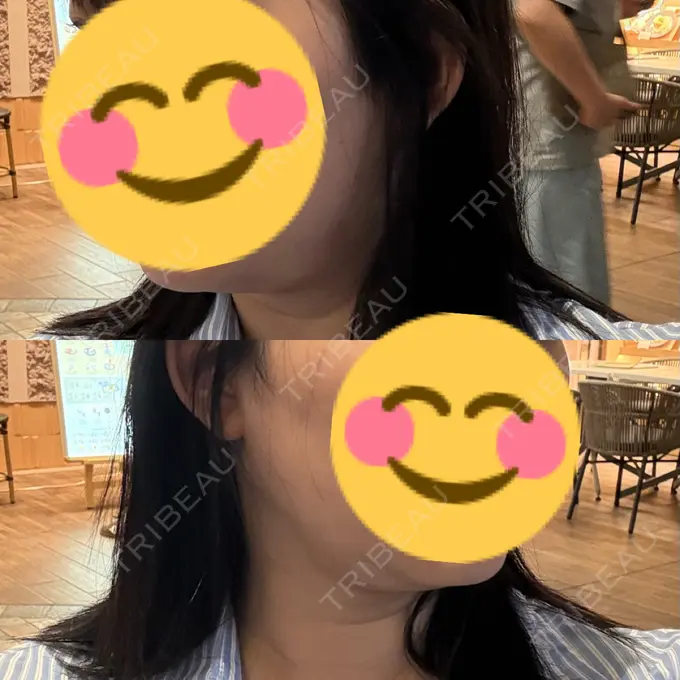 脂肪吸引（顔） / 脂肪吸引注射（顔） ziz CLINIC DAY 1 メイン用